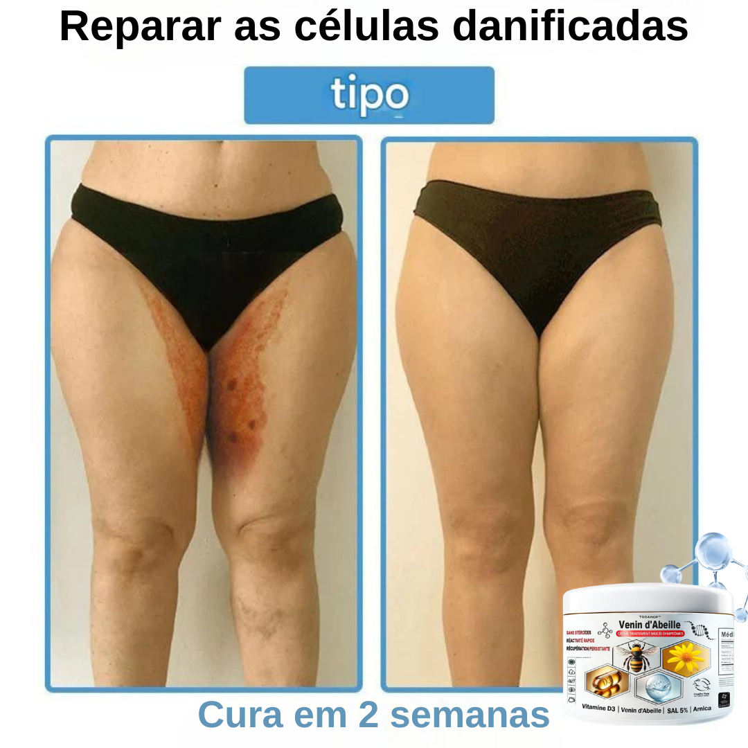 Creme anti-inflamatório multi-sintomas com veneno de abelha (OFERTA 2X1)