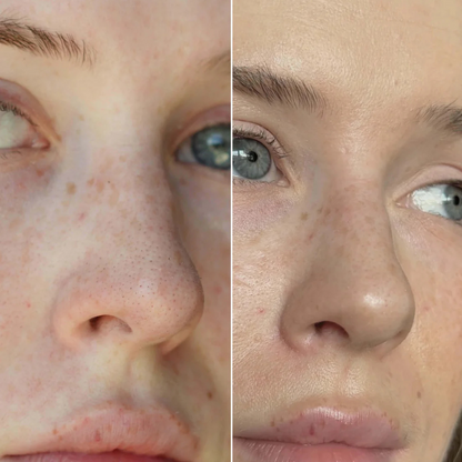 Patches Purificantes para o Nariz para Remover Pontos Negros e Oleosidade (OFERTA 2X1)